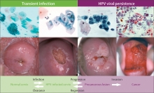 防预子宫颈癌的HPV治疗性疫苗研究