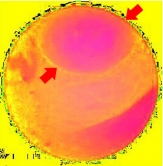 Intestinal polyp image after having its hue, saturation and intensity analysed by the system