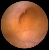 Normal intestinal image taken by a capsule endoscope