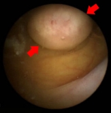 Intestinal polyp image taken by a capsule endoscope