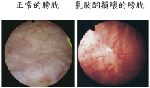 Ketamine abuse accounts for chronic inflammation and irreversible fibrosis of urinary bladder.