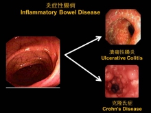 受炎症性腸病影響的腸道