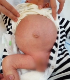 A baby with Hirschsprung’s disease