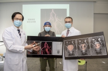 A study conducted by CU Medicine confirms the thickness-to-height (T/H) ratio of intravesical prostatic protrusion can effectively predict the treatment outcome and occurrence of post-procedure adverse events in BPH patients receiving PAE. 
(From left) Professor Simon YU, Chairman of the Department of Imaging and Interventional Radiology; BPH patient Mr. Tam; and Professor Anthony NG, Director of the S.H. HO Urology Centre of the Department of Surgery, CU Medicine.