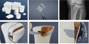 冷凍3D列印含鎂可降解高分子骨修復活性人工骨和填充骨缺損作臨床應用。