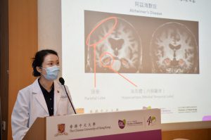 Professor Winnie CHU says it is very difficult to detect the presence and pattern of brain atrophy at the early stage by visual inspection when there is only mild cognitive impairment.