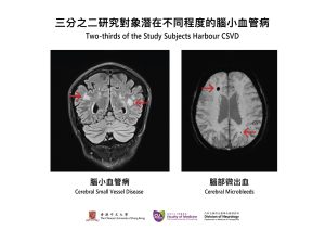 CSVD is a leading cause of stroke and dementia. It might have no obvious clinical symptoms at the initial stage, but it can be detected by brain imaging.