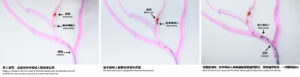 By deploying a tPA-nbot-loaded catheter to the thrombus site, the tPA-nbot microswarm is remotely actuated to the blood clot within vessels of submillimetre size, initiating the tPA-mediated thrombolysis process. After the blood clot is lysed, the tPA-nbots will be guided back for retrieval.