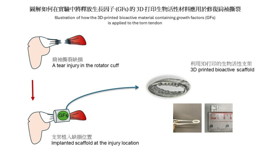 Illustration of how the 3D-printed bioactive material containing growth factors (GFs) is applied to the torn shoulder tendon.