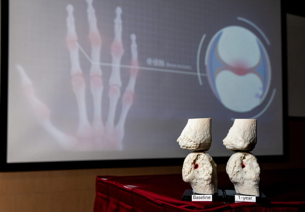 The 3D bone model on the right shows the partial healing of bone erosion a year after IL-17 inhibitor treatment.