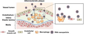 The spherical RNA nanoparticle contains a poly (ethylene glycol)-coated iron oxide nanoparticle inner core and an outer three-dimensional shell of microRNA-146a oligonucleotides. Upon intravenous injection, the RNA nanoparticle can accumulate in the atherosclerotic plaque and enter macrophages and endothelial cells inside the plaque.