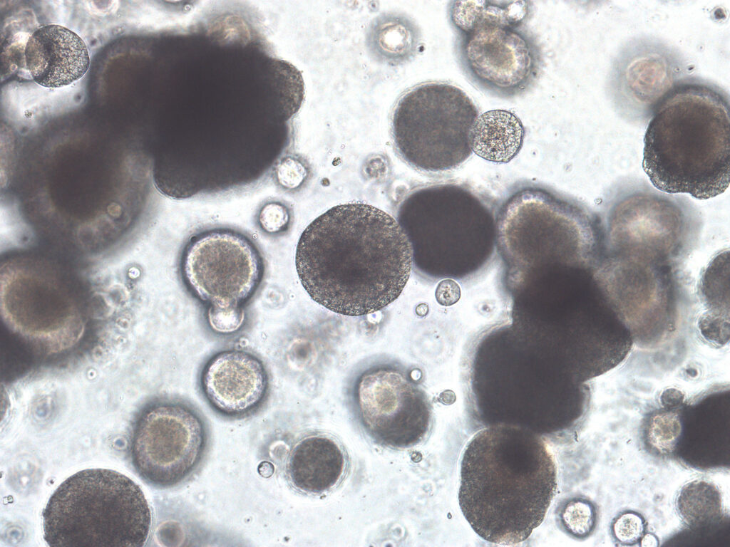 中大醫學院成立首個以亞洲族群為基礎的膀胱癌患者類器官生物庫，涵蓋36個膀胱癌類器官模型，全部來自香港公營醫院系統內56名膀胱癌患者的腫瘤樣本。類器官作為在體外培育而成的立體細胞結構，可模擬部分結構組織和功能，協助醫生了解疾病機制，分析腫瘤中多種基因變異及進展，並用作藥物篩選。