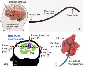 a)	用於腦出血抽吸的手術機械人插管圖示。<br />
b)	大腦側視圖：當插管以 “C”形插入軌跡進入腦血腫時，可避開重要的腦功能區，同時保持插管沿腦出血的長軸方向插入。 <br />
c)	柔性的插管尖端具備精準且靈活的遠端操作能力，以便在腦血腫內部進行操作。